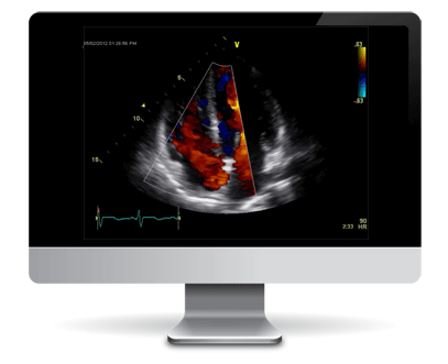 Echocardiogram